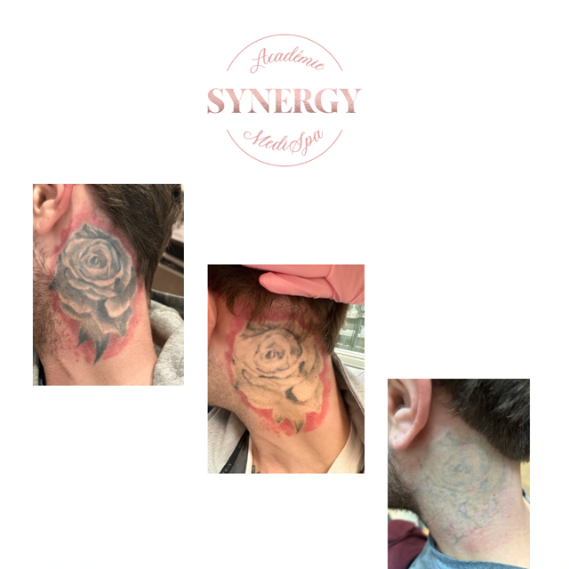 Laser tattoo removal Synergy Medispa