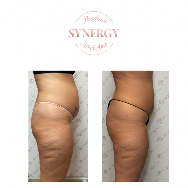 B-Shape Synergy Medi Spa