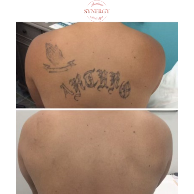 Laser tattoo removal Synergy Medispa