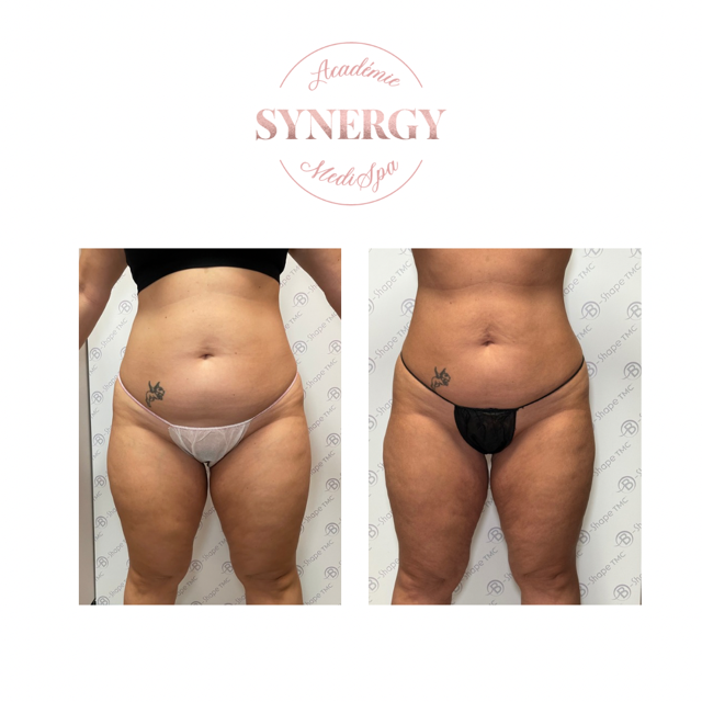 B-Shape Synergy Medi Spa