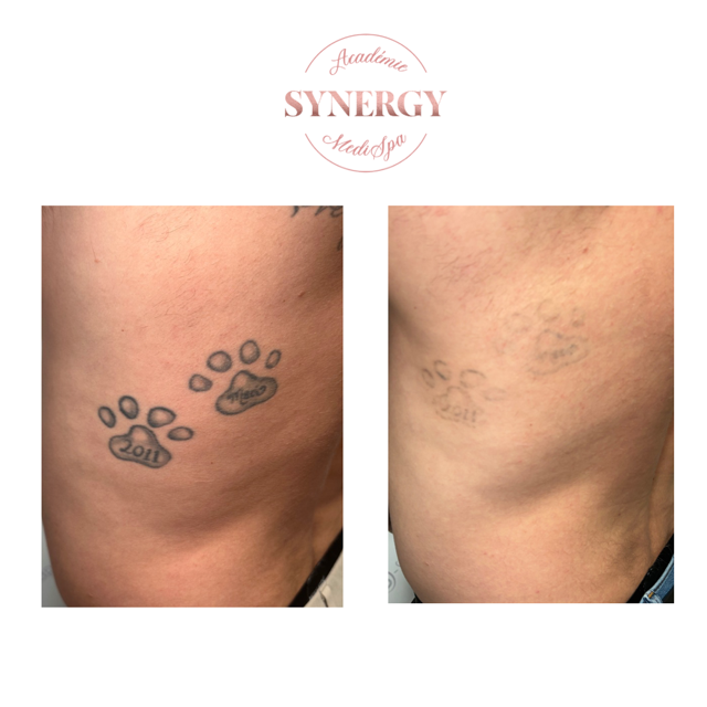 Laser tattoo removal Synergy Medispa