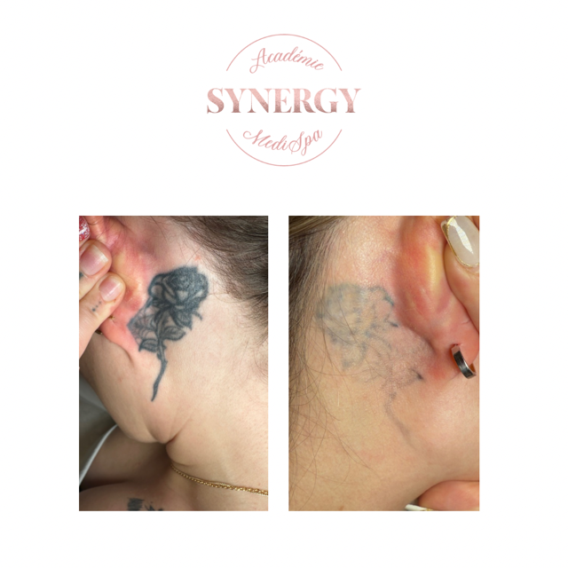 Laser tattoo removal Synergy Medispa