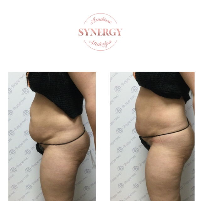 B-Shape Synergy Medi Spa