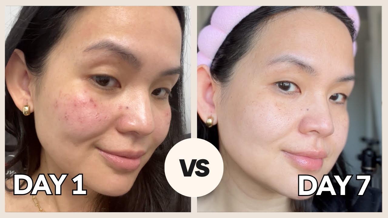 Hollywood Laser Peel