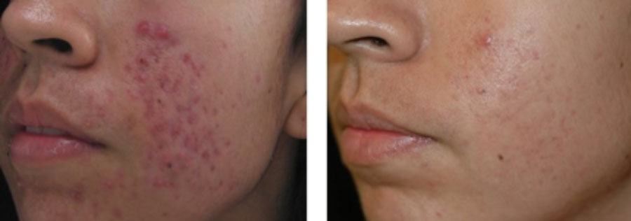 Hollywood Laser Peel