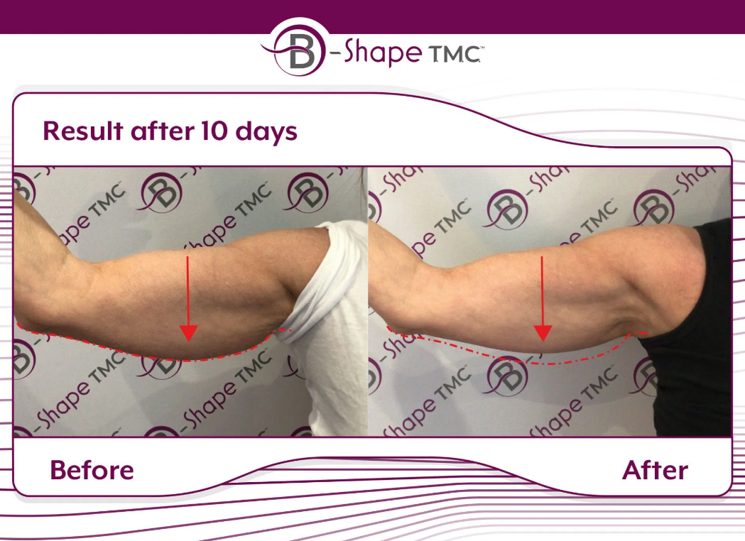 B-Shape