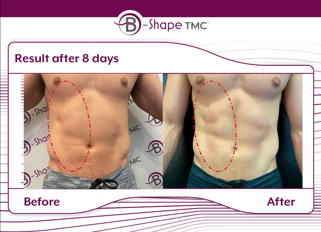 B-Shape