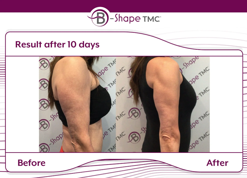 B-Shape